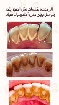 الي محتاج تنظيف ل اسنانه يتواصل وياي مجاني ٠٧٨١٢١٩٨٥٩٥