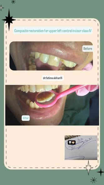 🔴مجاني تماما وتحت إشراف اطباء اختصاص 🔴يتوفر في عيادتنا قلع الأسنان المتحركه واللبنية وبقايا الجذور  من عمر ١٢فما فوق، تعويض الأسنان المفقودة بطقم جزئي متحرك، تنظيف الأسنان من التكلسات والتصبغات حشوات ضوئية للحجز والاستفسار على ***********عيادات جامعه اوروك كرادة 52مجاور مركز شرطه العلويه مقابل مطعم نانار
