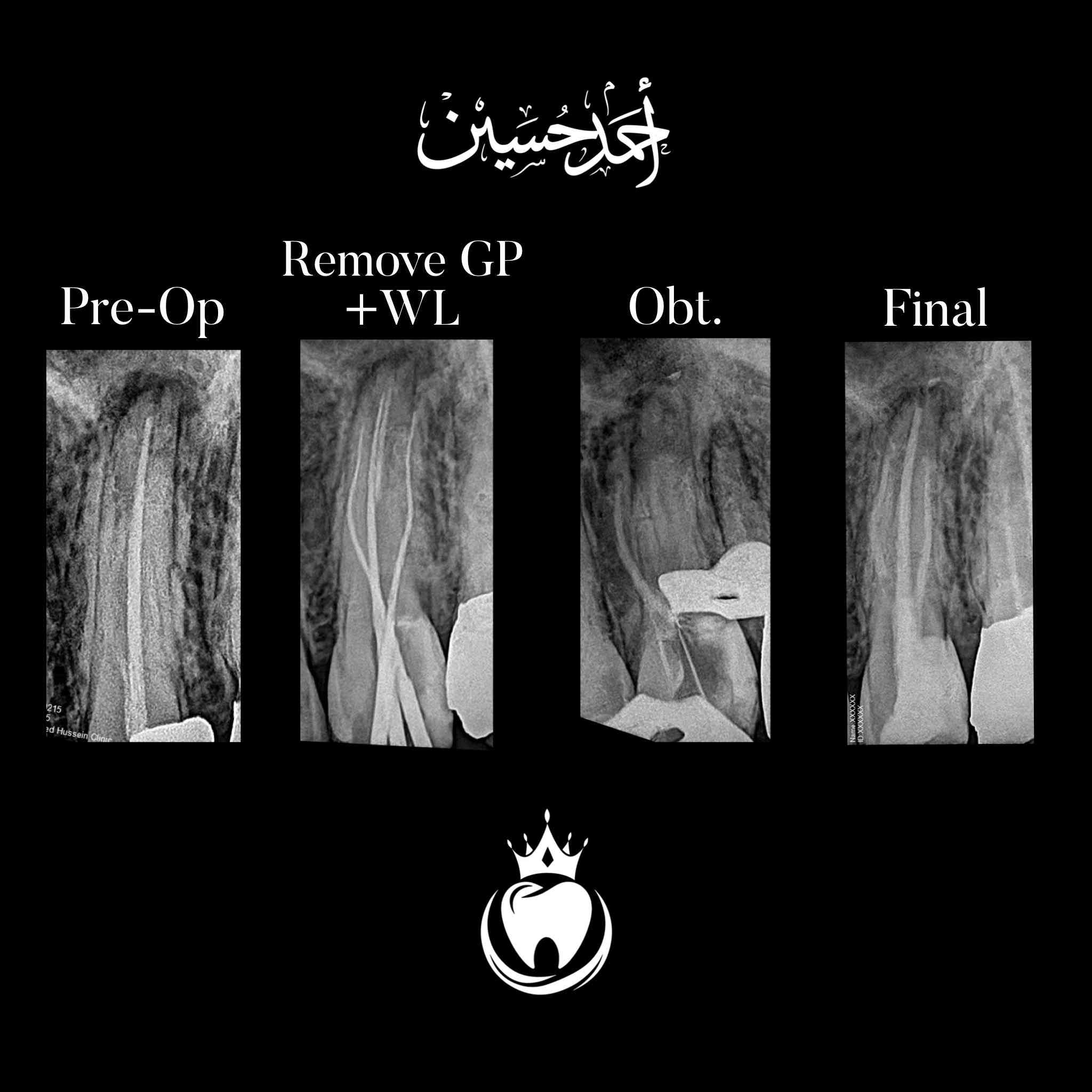 زارنا مراجع عنده ألم بسنه بعد الفحص و الاشعة تبين وجود مشكلة في حشوة الجذر لهذا السن 
حيث تم اعادة حشوة جذر المعمولة بشكل خاطئ لسن ضاحك علوي🦷 
مع وجود التهاب تحت الجذر  نتيجة عدم تحشية كافة قنوات السن 
واستبدال الحشوة المعدنية ب حشوة ضوئية و استعادة وظيفة و شكل السن الطبيعي الشرح تحت الصور  

الدكتور احمد حسين الطعماوي 
المكان : ناحية الزاب -المجمع الطبي الحديث مجاور مرطبات كرزة
للحجز و الاستفسار : ***********
