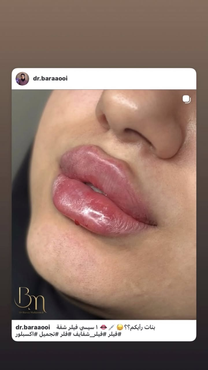 استغلوا عروض العيد من عيادة اوليفيا للتجميل
العنوان : الجريخي مجمع الصدرين الطبي الطابق الثاني 
٠***********
