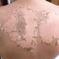 مقشر الأحماض • تقشير للعيد