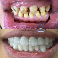 تجميل الأسنان • ابتسامة زاركون • ذي قار