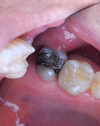 استبدال حشوة بلاتين قديمة بحشوة تجميلية بيضاء ✨ لوحظ وجود تغيّر بلون ا...