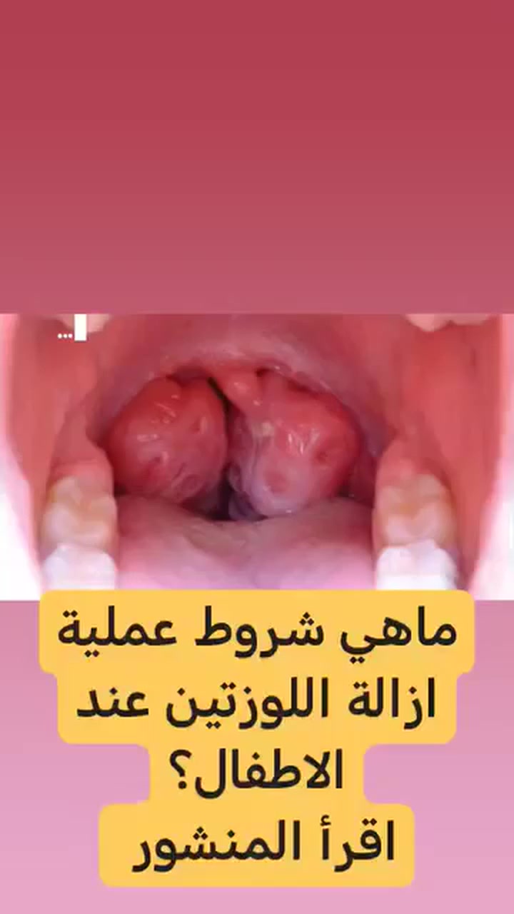 أهم أسباب  استئصال اللوزتين عند الأطفال 

اولا
 هو تضخم حجمهما حيث تسبب : 
الشخير  أثناء النوم  

ثانيا
 صعوبة وانقطاع التنفس أثناء النوم . 
و هذا بعد عدم استجابة العلاج  بالأدوية

ثالثا
وجود تاريخ عائلي بالتهاب اللوزتين المزمن من جهة الاب او الام

رابعا
التهاب اللوزتين خمس مرات فما فوق خلال السنه

خامسا
الشكوى المزمنه من مغص البطن او الم في مفصل الركبتين للطفل

في الصورة  حجم اللوزتين كبير جدا حيث تؤثر  على التنفُّس و البلع

دمتم واطفالكم بألف خير

الدكتور
احمد محمود عبدالله
طبيب الأطفال والخدج وحديثي الولادة

العنوان
بغداد حي الحسين مجمع التقى الطبي قرب مجمع النمور مقابل كوزمتك الفرج

للحجز والاستفسار
*********** 

👍❤️ لاتنسو المشاركة والاشارة للاصدقاء
لنشر المعلومة الطبية الصحيحة وتعم الفائدة للجميع...
