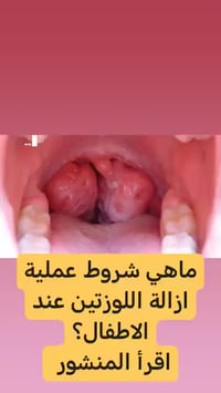 أهم أسباب  استئصال اللوزتين عند الأطفال   اولا  هو تضخم حجمهما حيث تسب...