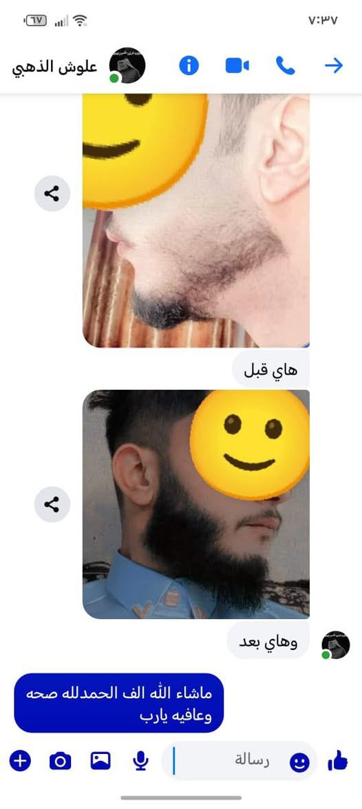 #تجارب #زيت الحية الاصلي 
متابعيني ()… اي شخص عنده مشكلة بشعره عندي علاج زيت الحية او دهن الحية الاصلي يعالج جميع مشاكل الشعر واللحية والشوارب والحواجب .. خلال 15 يوم يتوقف التساقط  ثخن وطول ونعومة وكثافة خلال شهر يبين عندك  امانة الله ….. يستخدم للرجال والنساء والاطفال ..للحجز راسلوني  خاص …•••••او راسلوني على الواتس اب ( ***********)
