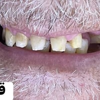 تعويض اسنان • زراعة اسنان • تركيب اسنان • اسنان زركون • ابتسامة هوليود...