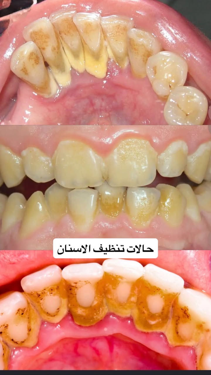 السلام عليكم💗💗
استقبال المرضى في عيادات كلية طب الأسنان في جامعة اهل البيت (ع).

المعالجة مجانية وبإشراف أخصائيين 

المعالجات المتوفرة:
🔶قلع أسنان
🔶التعويضات بأطقم متحركة
🔶 حشوات ضوئية 
🔶تنظيف الاسنان وازالة التكلسات 

الرجاء التواصل على الحسابات التالية:

الإنستغرام: 10_marb 
الواتساب:***********
