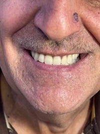 ابتسامة جديدة تمت في عيادة الإتقان  بيد الدكتور محمد جمال محمد  ماجستي...