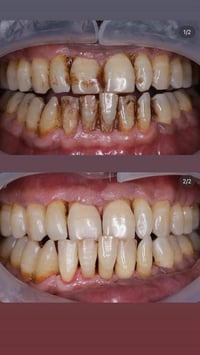 علاج أسنان مجاني • حشوات ضوئية • الجامعة العراقيه الاعظميه