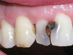 السلام عليكم أنا طالبة طب أسنان مرحلة خامسة ويتوفر لدينا:
١- قلع الاسنان التالفة
٢_ عمل طخم كامل أو جزئي للأسنان المفقودة 
٣_وضع مادة الفلورايد للاطفال لتجنب التسوس 
٤_ حشوات جذر للأسنان الامامية 
٥_ علاج حالات التسوس كما في الصورة
للتواصل : 
ماسنجر : SA Altaee 
واتساب: ***********
المكان : كلية طب الاسنان جامعة الموصل قرب متنزه الكفائات
