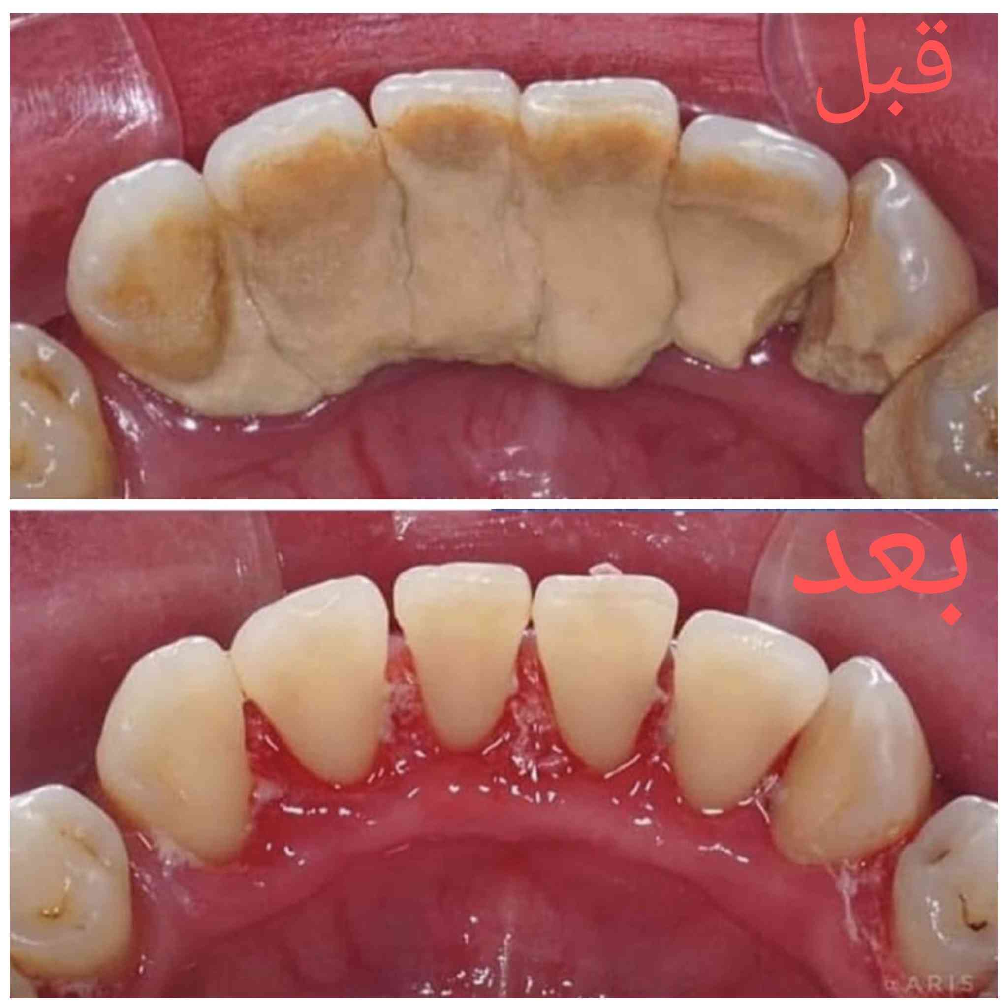 ⚠️ جير الأسنان يسبب:
نزيف وتراجع باللثة وسقوط الأسنان بالاخير 
الحل؟ تنظيف احترافي مثل هالحالات 🦷
الي عنده نفس هالحالات متوفر تنظيف مجاني 
للتواصل على الخاص  
او واتساب ***********
