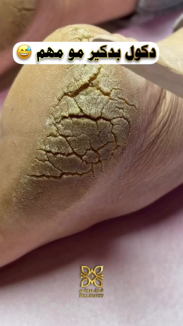 متوفر مادة الكالوس لإزالة الجلد الميت


**إذا كنت صاحب هذا الإعلان وتريد حذفه لأي سبب، رجاءا أرسل رسالة إلى الدعم الفني**