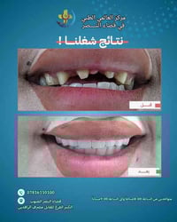 فحص مجاني • تركيب زاركون • قضاء النصر