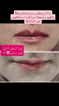 فلر شفايف • فلر ايطالي • المسيب حي المعلمين