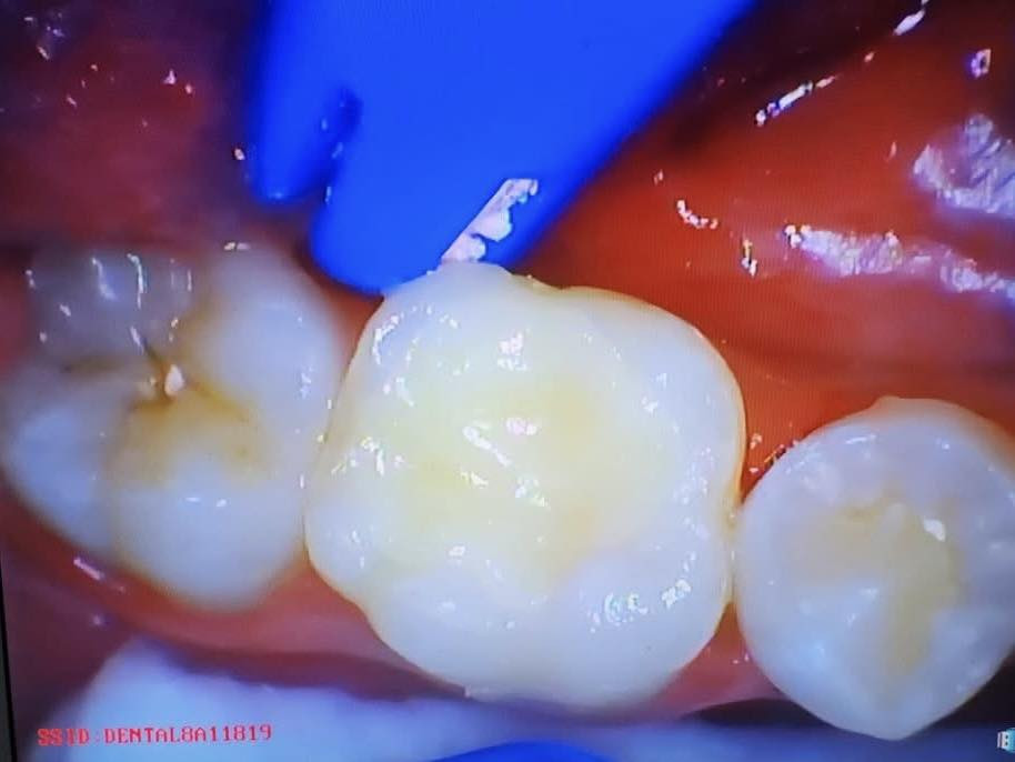 حشوة جذر للسن الخلفي
طبيب الاسنان الاختصاص د.عمار عباس
ماجستير تقويم وتجميل الاسنان M.S.c ortho
بكلوريوس طب وجراحة الفم والأسنان B.D.S
بغداد الشعب شارع عدن قرب  مركز شرطة الشعب  مدخل سوق شلال عمارة باريس الطابق الاول دوام العيادة جميع ايام الاسبوع ما عدا الجمعة عطلة من ٤ ل ٨  بدون حجز مسبق الدخول حسب اسبقية الحضور للعيادة الفحص والمعاينة مجاني للاستفسار ***********
