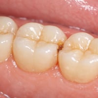 علاج تسوس • مجاني • الحله شارع 40