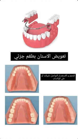 السلام عليكم..
🟢 خدمـــة مجــانية 

1⃣ قلع جذور الاسنان المتبقية ✅

2⃣ تعــويض الاسنان المفقودة بطقم جزئي متحرك ✅

الموقع بغداد كرادة شارع 52 عيادات جامعة اوروك

التواصل خاص او واتساب ***********
