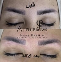 ازالة تاتو • الفي ريموفل • المحمودية حي الرشيد