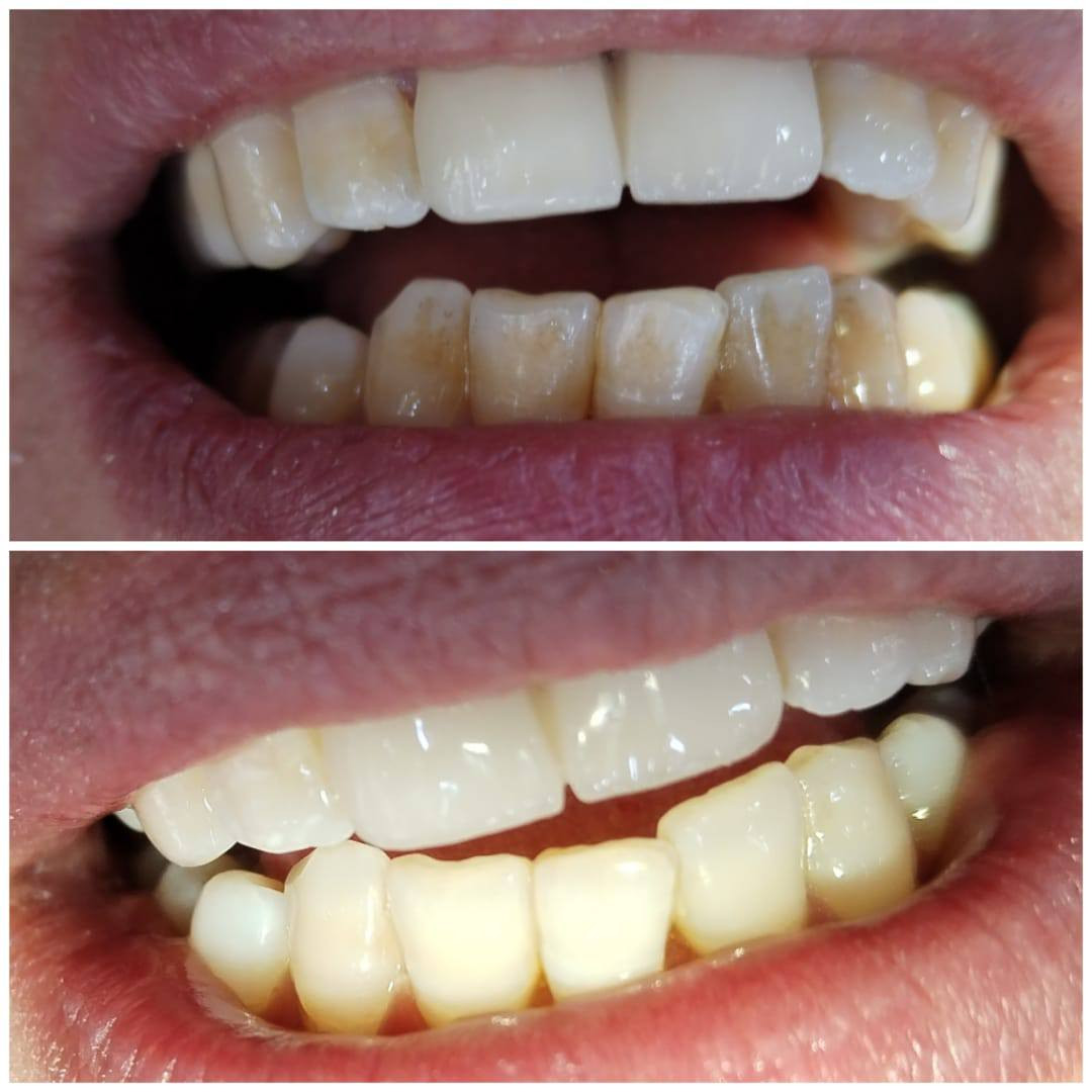 السلام عليكم 
غدا اخر يوم مجاني لمواعيد تنظيف الاسنان 
اللي يحتاج تنظيف اسنان يتواصل وياي واتساب على الرقم 
***********
العنوان :شارع اربعين،مجاورصيدلية سلامتك اولا ،قرب شارع ابو خمرة
