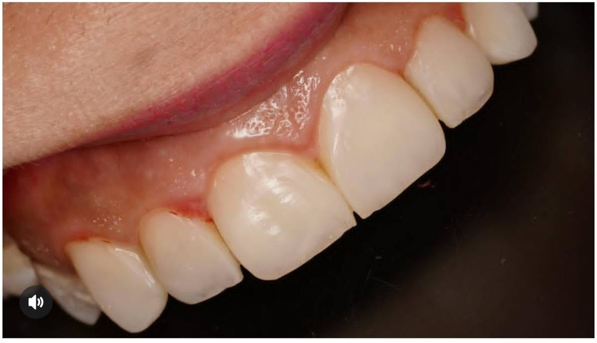 تتوقع اسنانك ما الهن حل ؟

بعيادتنا اغلب المراجعين الي يزورونا يتوقعون اسنانهم بعد ما الها علاج ولازم تنقلع ، بس اطبائنا الهم رأي اخر 😀

زورنا للعيادة وراح نرجع اسنانك لحالتهن الطبيعية ونرجع ضحكتك الحلوة 💎

عيادة آلرواسي  - افضل اختيار لصحة اسنانك

العنوان: الحريه - سوق الدولعي - ثاني فرع ع اليمين  
للحجز والاستفسار: بأمكانكم مراسلتنا عبر رسائل الصفحة
او الاتصال بنا على الرقم ***********
