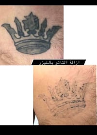 ازالة وشوم • البصرة • أحدث أجهزة