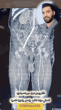 #انقاذ_الاطراف_من_البتر
#زراعه_الشريان_الابهر
عقابيل انسداد تام للشريان الابهر البطني مع شرايين الحوض مع الشريان الفخذي الايمن..المريض مجراة له سابقا عده تداخلات في الدول المجاوره لكن لم يستفيد منها.. مع الم مزمن غير مستجيب للمسكنات مع فقدان القدره على المشي مع تهديد ببتر كلا الساقين.. تم اجراء عمليه زراعه الشريان الابهر بنجاح لمريضنا العزيز

#معالجه_دوالي_الساقين_والقرحه_الوريديه_بالطرق_الحديثه

#جميع_عملياتنا_مشموله_بدفتر_الضمان_الصحي
#الدكتور_حيدر _عجيل_جبر _الحسيناوي
#بورد_دكتوراه_جراحة_الصدر_والقلب_والاوعية_الدموية
#معالجة_قدم_السكري_مع_الضمان_بعدم_البتر
#اجراء_جميع_عمليات_زراعة_الشرايين
#قسطرة_شرايين_الاطراف
#عمليات_تصليح_تشوهات_وكسور_القفص_الصدري
#عمليات_تصنيع_القصبة_الهوائية
#رفع_جميع_الاورام_والاكياس_بالقلب_والرئتين_بالناظور_والعمليات
#تنظير_المريء_والقصبة_الهوائية
#عمليات_الربط_الدائمي_والمؤقت_لمرضى_العجز_الكلوي

🗓️ايام الدوام في العيادة الاثنين و الخميس

‏العنوان 📍
بغداد / المنصور - شارع أبو جعفر المنصور - سايد كباب محمد - فوق صيدلية انكيدو 

‏رقم الهاتف للحجز 📱
***********
