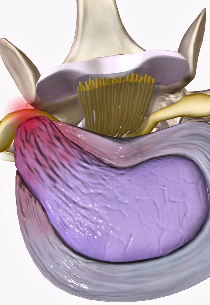 الانزلاق في #الغضروف توجد به 3 درجات ...

بالفيديو الدرجه #الثالثه وهي الأصعب .

عافانا الله #وإياكم 

✨🌿 أهلاً وسهلاً بكم في عيادتنا #عيادة_العامريه_للعلاج_الطبيعي_والتأهيل_الطبي  🌿✨

المعالج الاختصاص/ حمزه محمد  
يوجد كادر نسائي 
ايام الدوام : يوميا ماعدا الجمعه 
📍 العنوان: [ عامرية الصمود - مجمع النور الطبي ] 
📞 للحجز والاستفسار: [  ***********  ]
