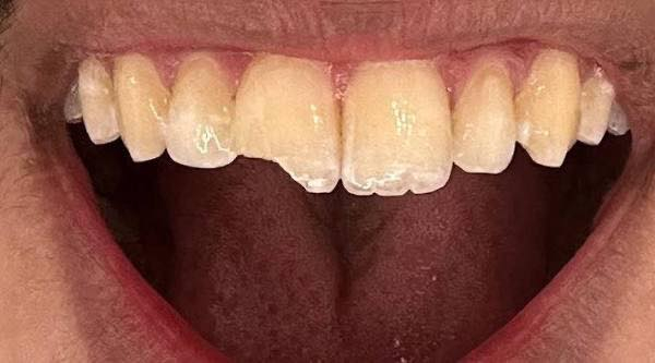 السلام عليكم الي عنده تسوس مثل الي بالصورة يتوفر علاج مجاني للمراسلة على الواتساب ***********
العنوان عيادات جامعة البيان على شارع المطار مقابل تمثال عباس ابن فرناس
