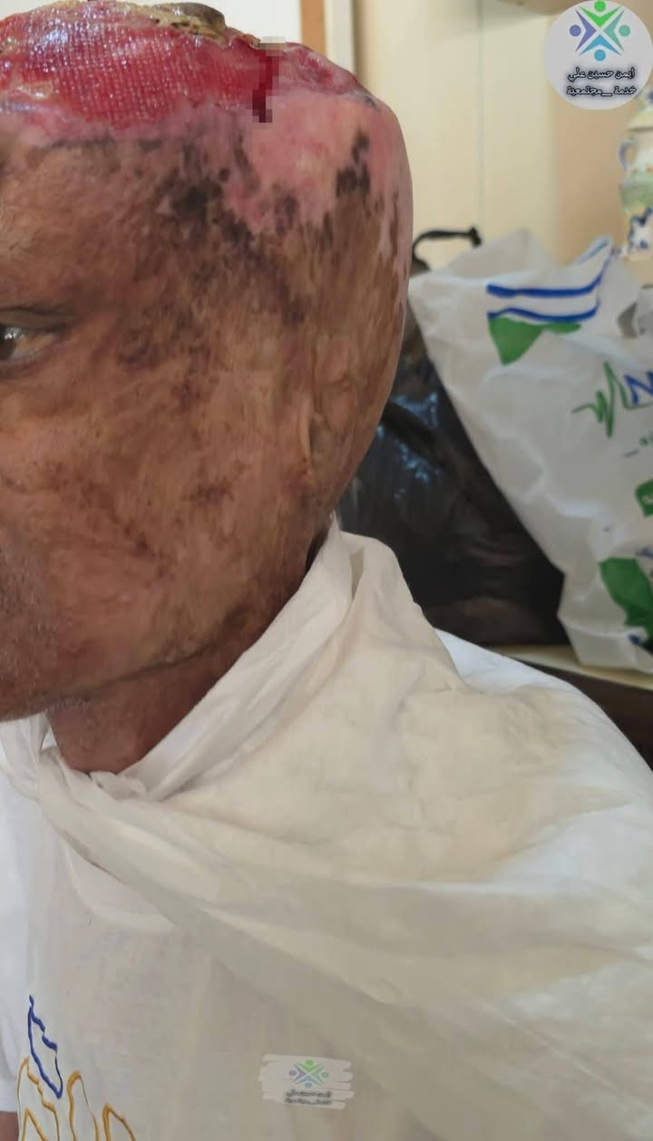 الأحد موعد الجرعة... من يتاجر مع الله؟
أخوكم مظفر يعاني من سرطان متقدم في الرأس تسبب بتآكل جزء من عظم الجمجمة، إضافة إلى الفشل الكلوي.

للأسف، هذه هي الجرعة البيولوجية الثالثة التي لم يتمكن من تلقيها بسبب عدم القدرة على شرائها.

💉 سعر الجرعة الواحدة: 800 ألف دينار عراقي.

أهل الخير ما يقصرون، والكلمة الطيبة صدقة، والتبرع ولو بمبلغ بسيط قد يكون سببًا في إكمال ثمن العلاج وإنقاذ حياة مريض.

للتبرع أو الاستفسار:
📞 ***********

💳 ماستر كارد:
910153839196

جزاكم الله خيرًا، وجعل ما تقدمونه في ميزان حسناتكم.
