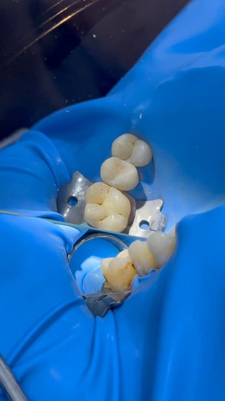 تم عمل حشوة تجميلية للسن واعادة رسم الشكل التشريحي للسن بجلسة واحدة فقط 
وتم الحصول على اتصال صحيح بين الاسنان لتجنب تجمع الاكل بهذا المكان بأستخدام العازل المطاطي لنضمن نظافة ونجاح الشغل اكثر 
نتواجد يومياً بالعيادة قبل الافطار من الساعه 3 ظهراً 
وبعد الافطار من الساعة 7:30 
الحجز على الخاص او الاتصال على الرقم ***********
