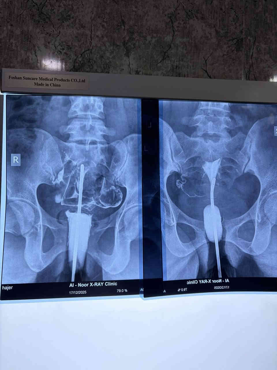 تتواجد غدا السبت ان شاء الله الدكتورة نهى فارس عطااللة الجبوري اخصائية الاشعة التشخيصية دكتوراه بورد عربي زميلة المجلس العربي للاختصاصات الصحية 
سونار ودوبلر ومفراس ورنين 
سونار ودوبلر البطن 
سونار ودوبلر اوردة وشرايين الاطراف العليا 
سونار ودوبلر اوردة وشرايين الاطراف السفلى 
سونار الثدي وسونار الغدد 
سونار ودوبلر العضلات والمفاصل 
سونار الدماغ للأطفال وسونار الخلع الولادي 
سونار الجلد وسونار العين 
يوجد في العيادة اشعة ملونة لفتح الانابيب 
عنوان العيادة القيارة شارع البيكمات مجمع الكوثر الطبي مقابيل روتانا مول 
اوقات دوام العيادة من الساعة الواحدة ضهرا إلى الساعة السابعة مساءا 
يوم السبت ويوم الأربعاء من كل اسبوع 
للحجز والاستفسار الاتصال على رقم العيادة ***********
