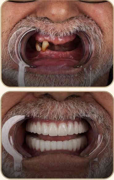 ✅مجانا مجانا مجانا✅
🦷 هل تبحث عن:

• تنظيف الأسنان (ازالة التصبغات والتكلسات)

• قلع أسنان او بقايا جذور

• حشوة ضوئية ( بيضاء)

• تعويض أسنان مفقودة (طقم اسنان)

الآن هذه الخدمات متوفرة في كلية طب الأسنان – جامعة الاسراء 

بإشراف دكاترة مختصين.

✅ جودة وأمان عالي

✅ علاج مجاني بالكامل

✅ مكان موثوق

كرادة ساحة الاندلس/عيادات جامعة الاسراء  

📞 للحجز والاستفسار مراسلتي على الخاص 

او على هذا رقم ***********
