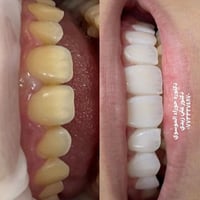 تجميل الأسنان • تنظيف الأسنان • واسط