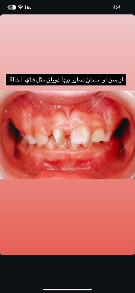 للاطفال من بعمر 9 او 10 الي عندهم مثل الحاله الي بالصورة تقويم مجاني بالبصرة والزبير للتوصل ***********
