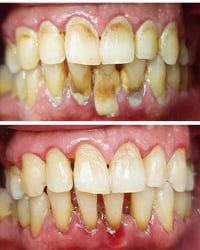 تنظيف أسنان • تكلسات قوية • جامعة بابل