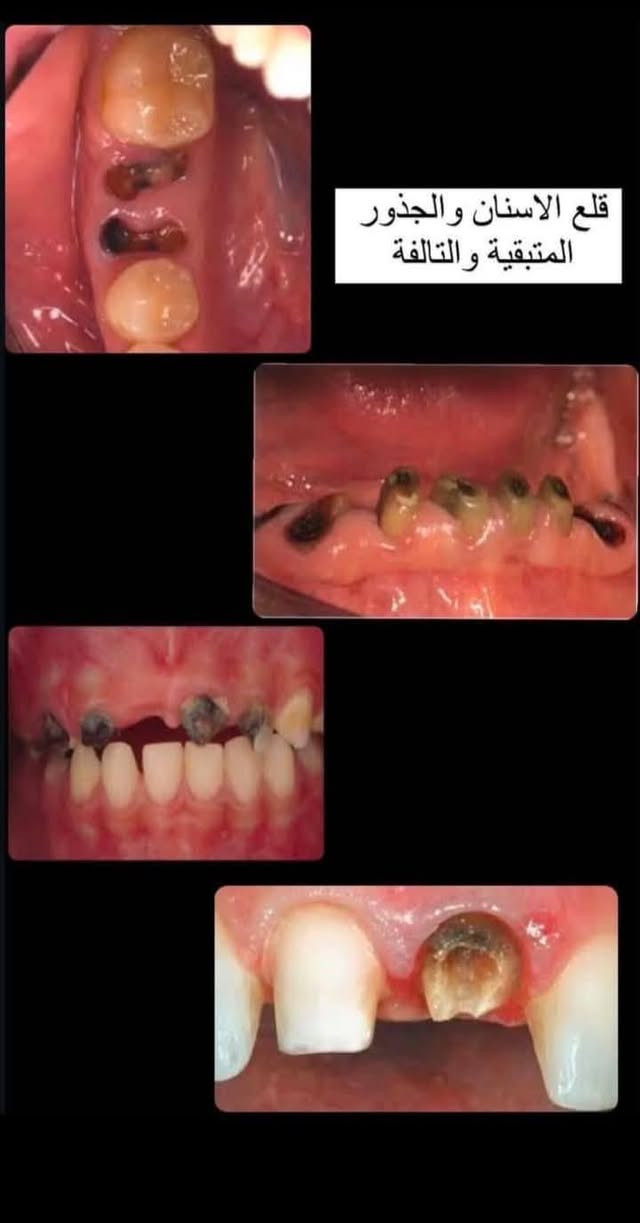 تعلن عيادات جامعة العميد لطب الاسنان عن استقبالها للمراجعين وتوفر حالات علاج الاسنان التالية :
قلع الاسنان والجذور المتبقية 

  تنظيف الاسنان من التكلسات  

تعويض الاسنان المفقودة بطقم متحرك 

العمل  مجاني وتحت إشراف أطباء إختصاص لجميع الحالات 
للحجز والاستفسار  *********** (واتساب)
