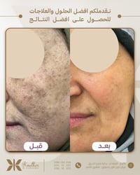 الرمادي • جلدية • ليزر