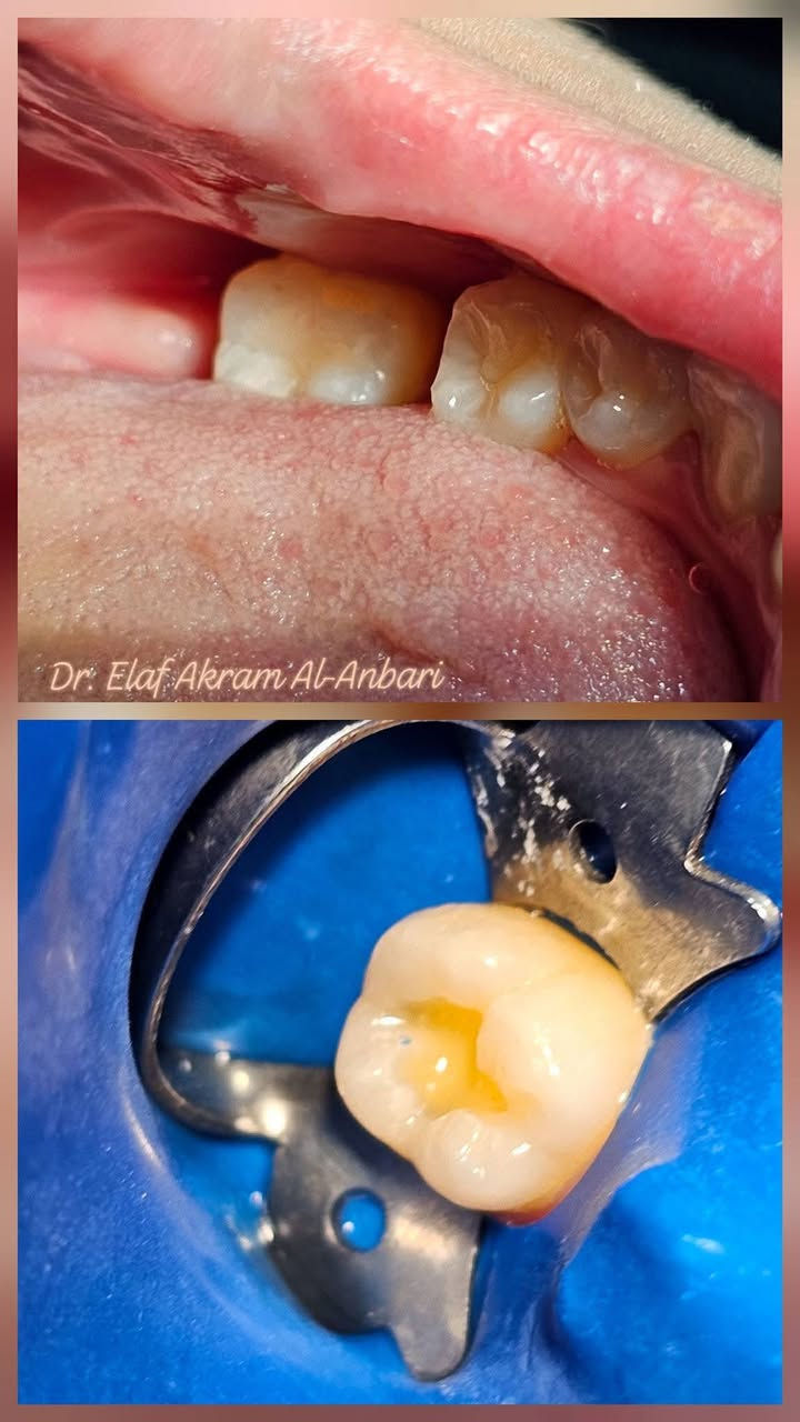 السلام عليكم
ابتداءاً من يوم الاحد راح ترجع العيادات التعليمية لجامعة الهادي تفتح
نستقبلكم من خلالها ونقدملكم علاج للاسنان من حشوات وتتظيف وقلع وتعويض بالاطقم المتحركة وهذا بعض شغلنا اني وزملائي وجميعهم جانوا راضين بالنتائج.
 للمهتمين تكدرون تتواصلون وياي ونرتب موعد سريع ومضمون ومجاني.
***********
