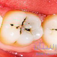 🦷💥 تسوس الأسنان؟ لا تقلق! علاج التسوس سريع وآمن، لن تترك أي ألم أو حسا...