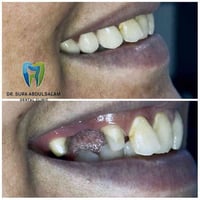 تعويض الاسنان المفقوده في عيادتنا   ... عيادة الدكتورة سرى العاني لطب ...