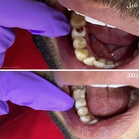 تسوس • ترميم سن • واسط بدرة
