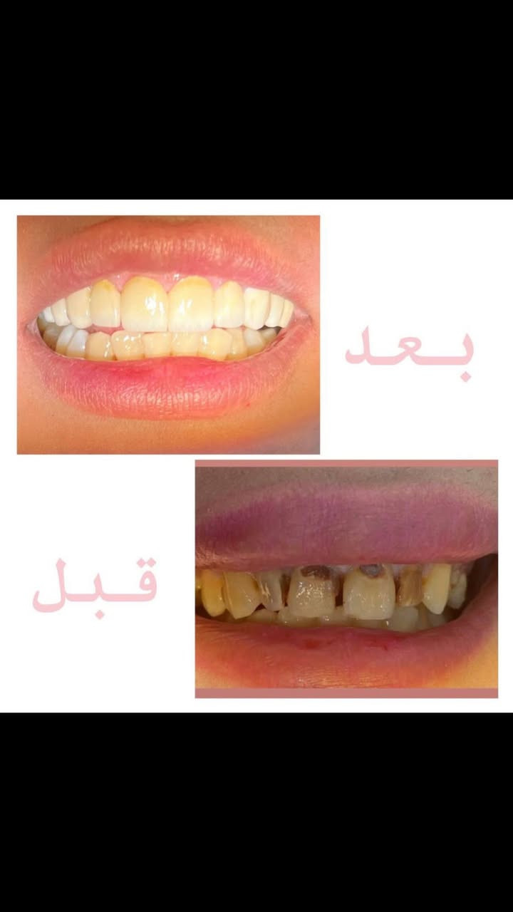 شنو الخبر الي ممكن يفرح اهالي الحسينية !؟ 
عيادة داليتا لطب وتجميل وتقويم الاسنان تقدم خصم 20٪ ع حشوات الجذور والحشوات التجميلية 
العنوان : الحسينية | قرب السوق الصغير | فرع صيدلية العجلان 
Dalya Majeed
***********
