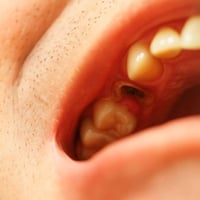 اذا عندكم مثل الحالة بالصور بقايا اسنان تالفة او اسنان تتحرك  تتواصلون...