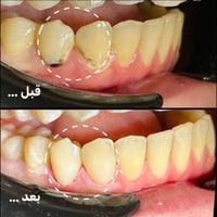 علاج أسنان • فحص دوري • علاج جذر