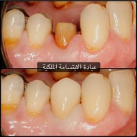 حشوة جذر • تاج زركون • سبع البور بغداد