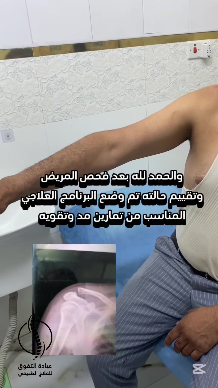 من الألم إلى الأمل 💪حالة إصابة بالكتف كان يعاني من صعوبة بالحركة،وبعد جلسات تأهيل طبي متخصص بعيادتنا… الفرق واضح!📍 عيادة التفوق – الحمزة الشرقي📞 ***********.  ***********#قبل_وبعد #علاج_طبيعي #إصابة_الكتف #تأهيل_عضلي #عيادة_التفوق”
