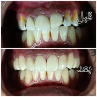ارجاع ابتسامة بتغليفات الزاركون لمراجع يعاني من تسوسات وتغليف معمول بص...