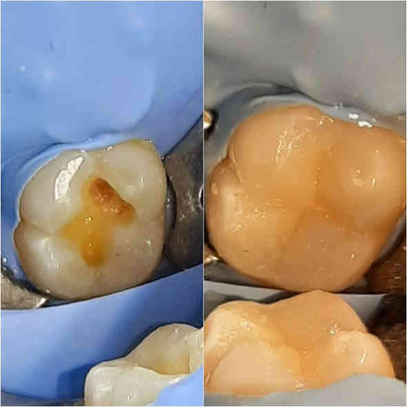 ⚡️ 30% خصم الآن!  عرض لا يُفوَّت! ⚡️

الدكتور وليد الفهداوي (بكالوريوس طب وجراحة الفم والأسنان
، سيرتفكت حشوات جذور ) يقدم :

​💰 العرض الأقوى (لفترة محدودة)!

​مجاناً: تنظيف وإزالة التكلسات والتصبغات عند حجز جلسة التبييض بالليزر!

​خصومات تصل إلى 30% على حشوات الضوئية و حشوات الجذور والقلع.

​فحص واستشارة مجانية لجميع الحجوزات.

​📞 احجز الآن!

للحجز ​اتصل على: ***********
العنوان: الرمادي _ الصوفية _ البومحل _ مجاور ملعب شهداء البومحل
