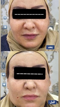 فلر شد • حقن تجميلي • المسيب